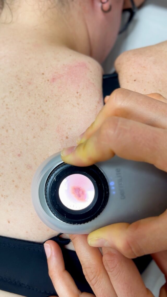 Euromelanoma-CSA